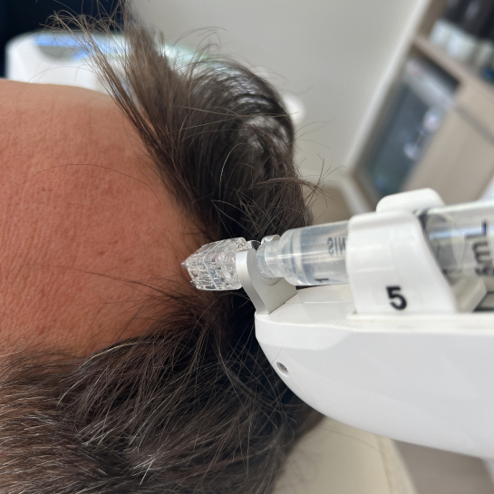 Hair Restoration (Growth Factor Therapy)