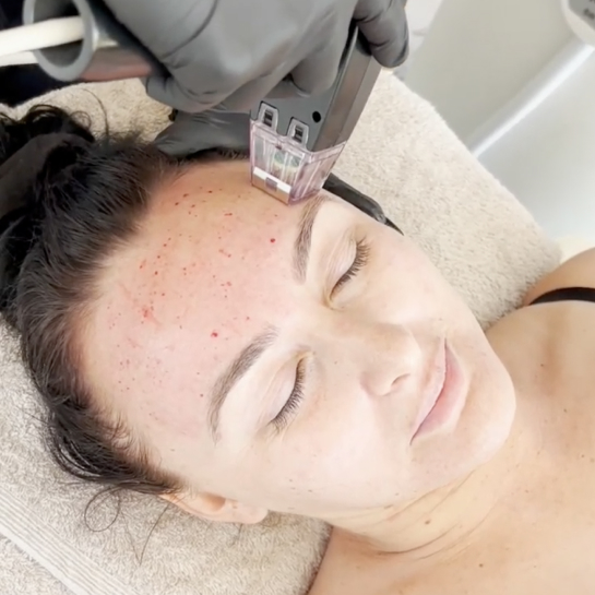 Skin Tightening (Morpheus 8 & Forma)