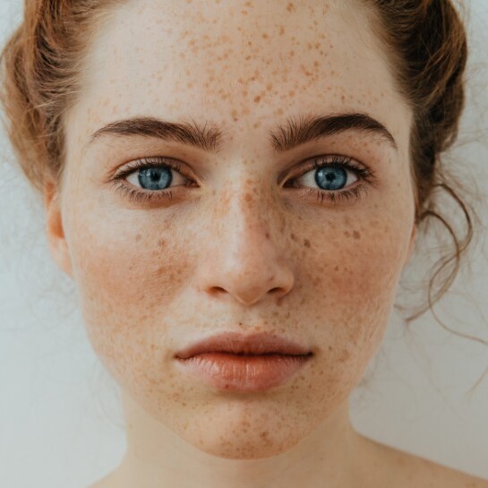Sun Damage & Hyperpigmentation