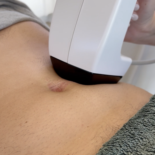 body contouring